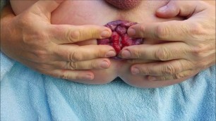 Self anal fisting my dirty prolapse