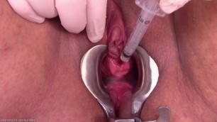 Squirting Cum Lube into my Bladder through my Stretched Urethra